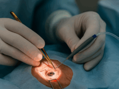 Одновременное лечение глаукомы и катаракты: особенности комбинированного лечения